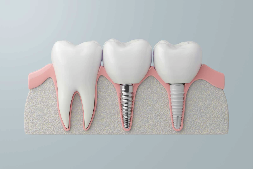 Implantes Dentales en Alaia Dental